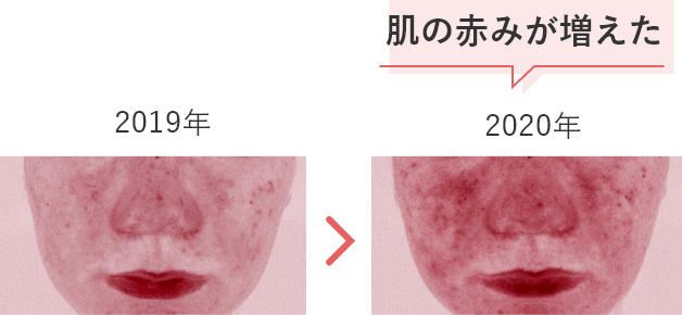 2019年、2020年の肌の赤みの比較写真