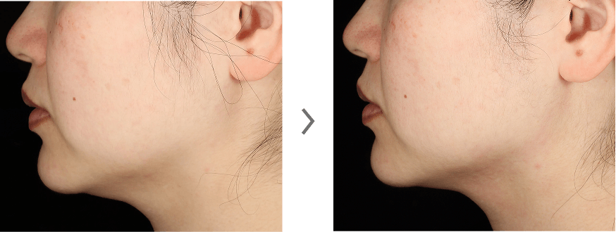 KOGAOメンテジェル使用前と使用後の肌の様子